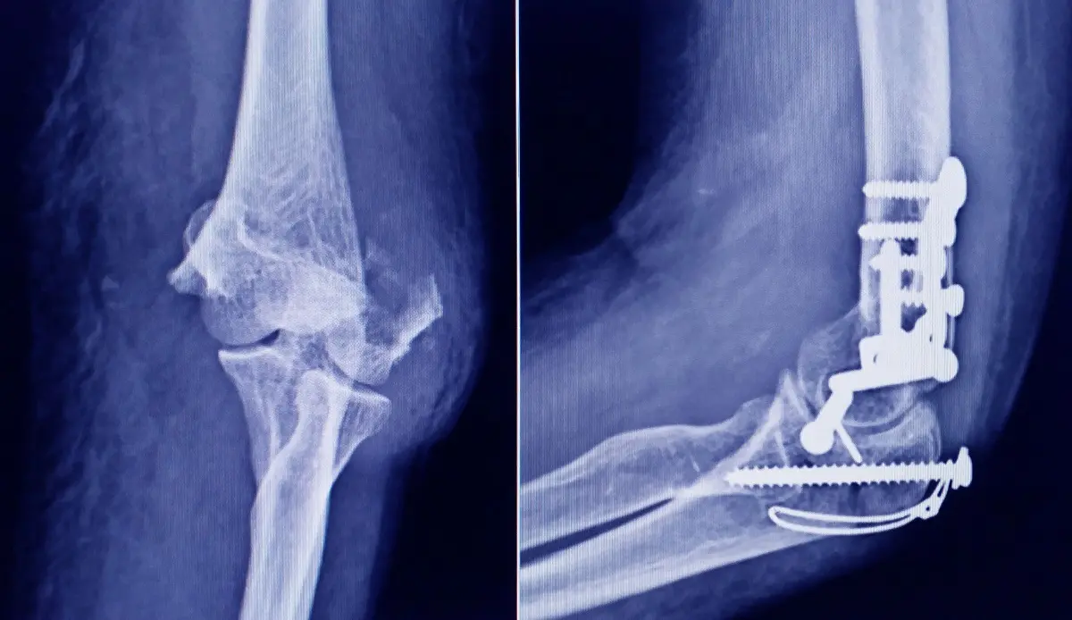 Traumatología y Osteosíntesis