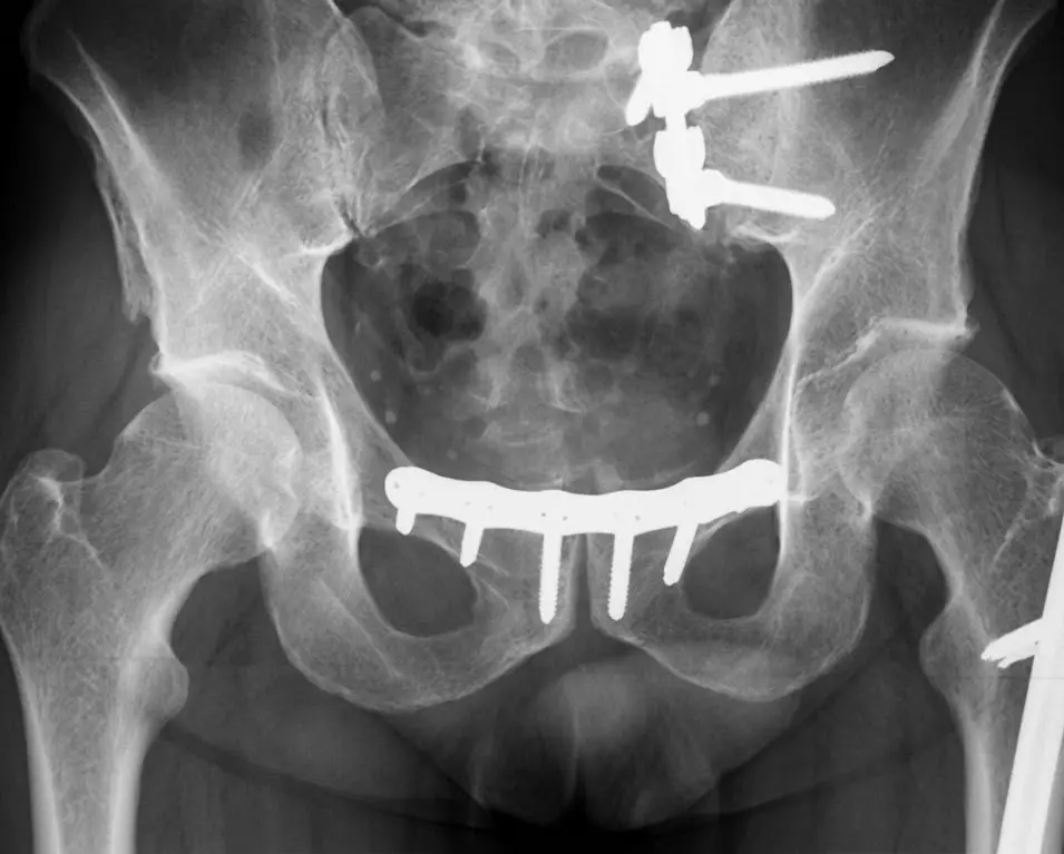 Implantes de alta gama para traumatología